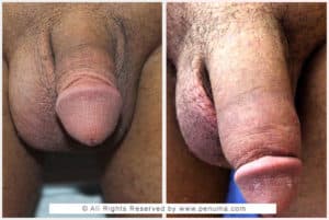 penis implant before and after with Dr. Tajkarimi