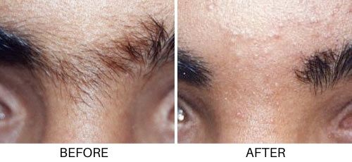 Laser hair removal before and after eyebrow hair at betterbodymd.