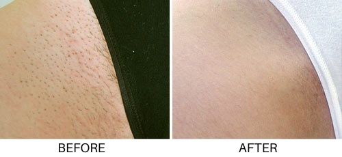 Laser hair removal before and after bikini area at betterbodymd.