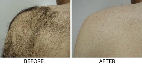 Laser hair removal before and after shoulder hair at betterbodymd.