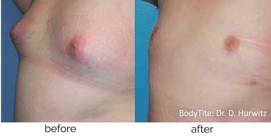 BodyTite Fat Reduction treatment at Better Body MD