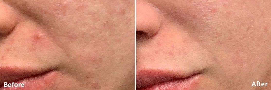 RF microneedling treatment at Better Body MD