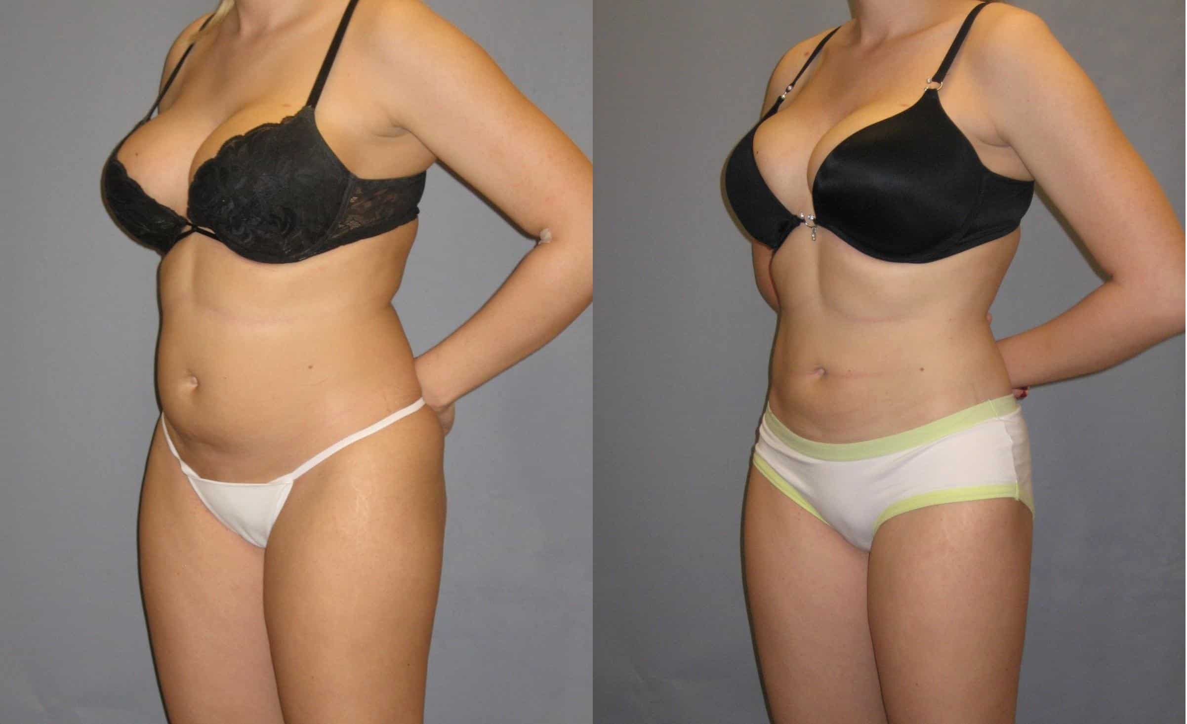 liposuction for women
