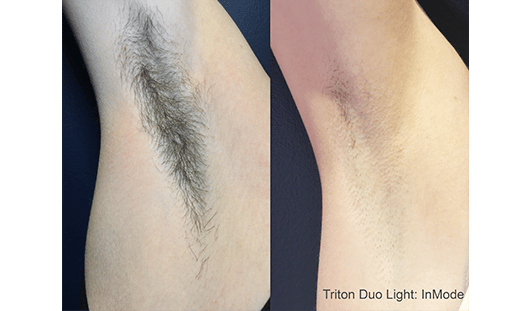 laser_hair_removal_before_and_after_treatment_1