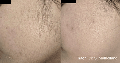 laser_hair_removal_before_and_after_treatment_3