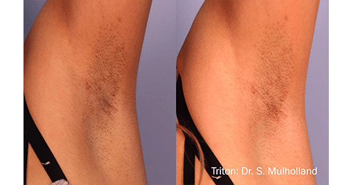 laser_hair_removal_before_and_after_treatment_4