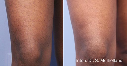 laser_hair_removal_before_and_after_treatment_5