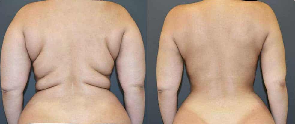 liposuction before and after treatment