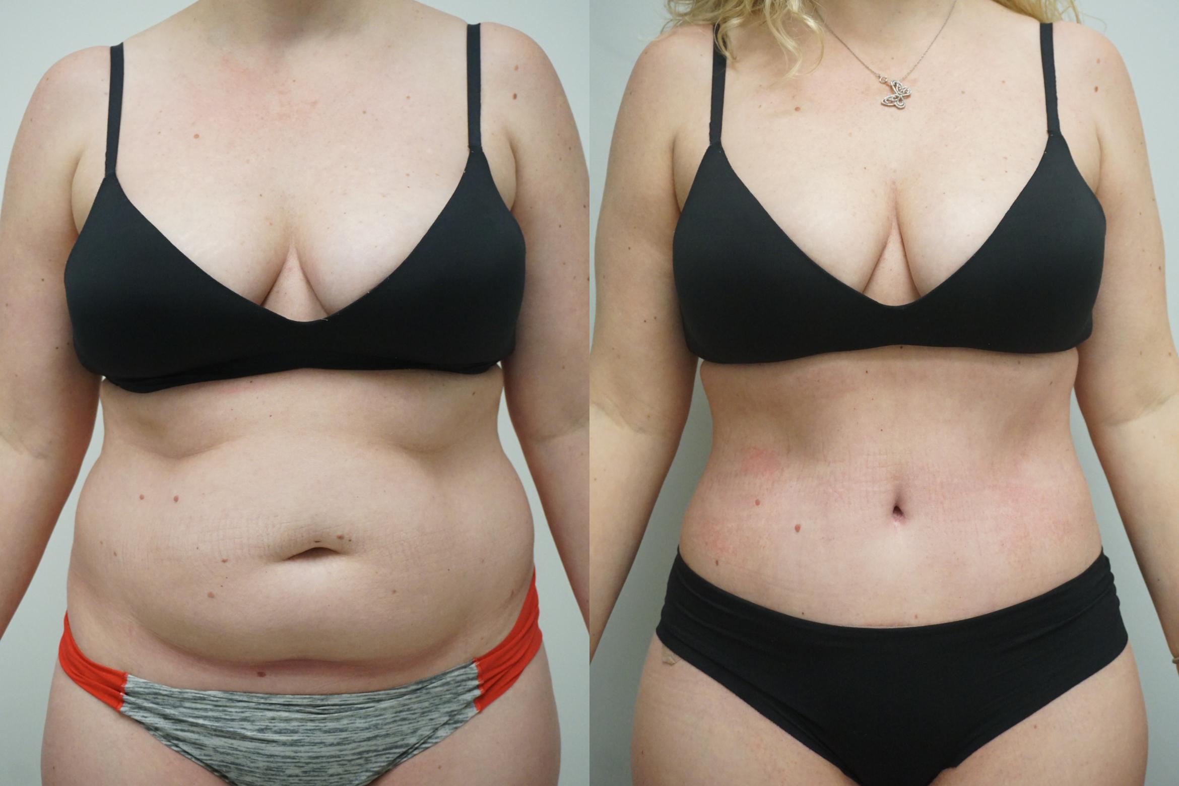 liposuction abdomen for women