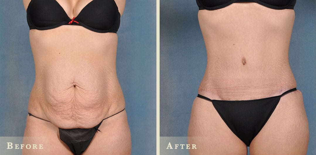 liposuction abdomen area for women