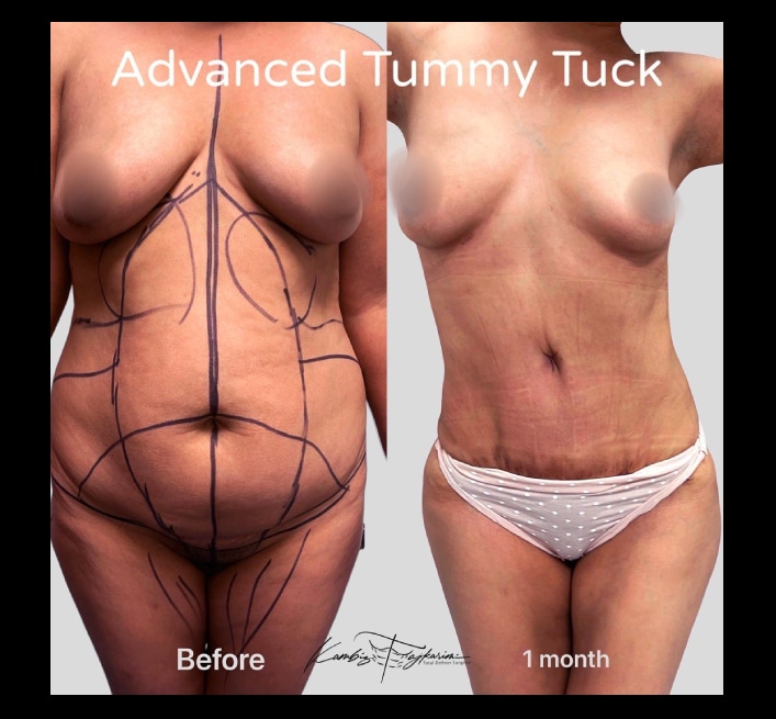 TummyTuck-Results-12