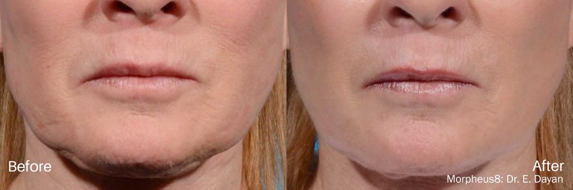RF Microneedling before and after betterbodymd 6 (2)